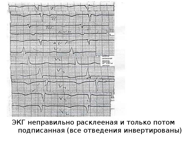 Неправильная экг