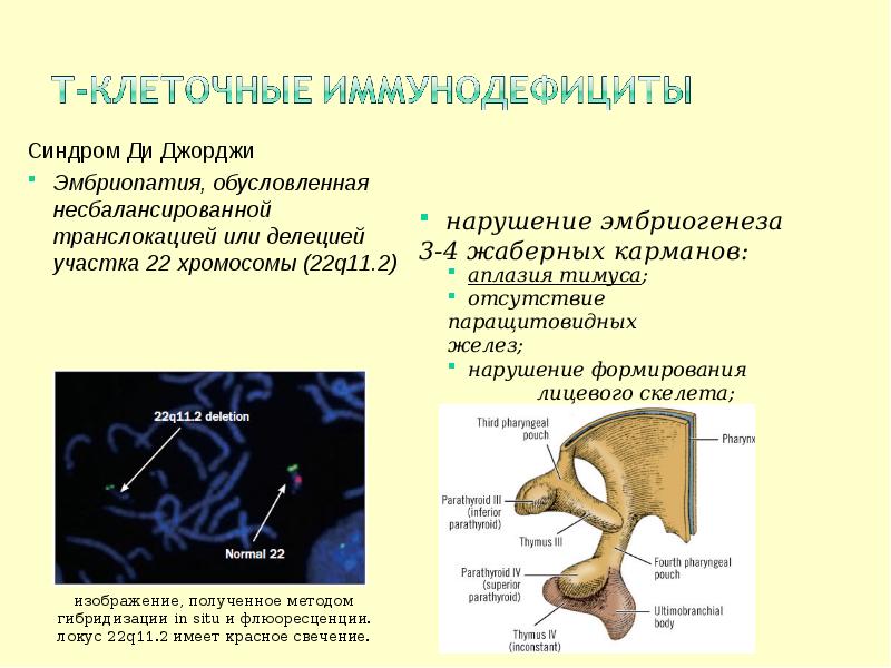 Синдром ди джорджи