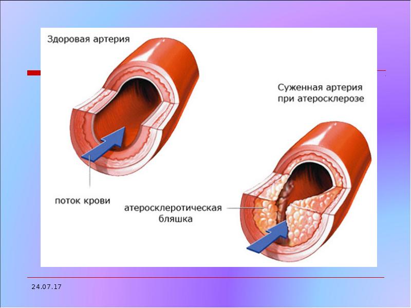 Атеросклероз сосудов презентация