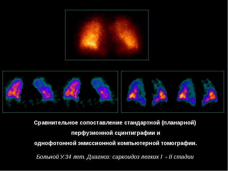 Сцинтиграфия схема получения изображения