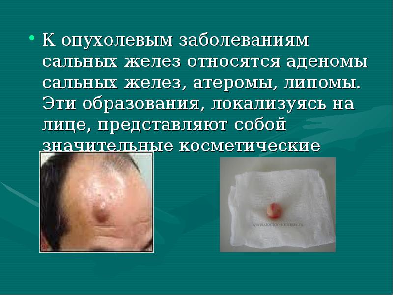 К опухолевым заболеваниям сальных желез относятся аденомы сальных желез, атеромы, липомы. К опухолевым заболеваниям сальных желез относятся аденомы сальных желез, атеромы, липомы.