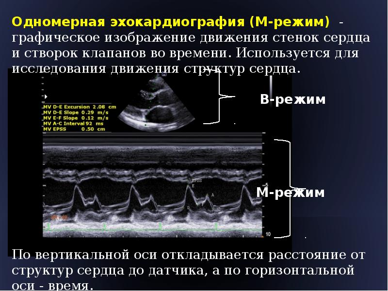 B режим. Эхокардиография одномерный режим. А-режим ультразвукового исследования. УЗИ. Одномерная ЭХОКГ В М режиме. Митральный клапан при ЭХОКГ В М режиме.