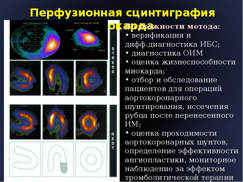 Сцинтиграфия миокарда. Перфузионная сцинтиграфия сердца. Сцинтиграфия перфузионная миокарда (нагрузочная). Перфузионная гамма сцинтиграфия. Динамическая сцинтиграфия миокарда.