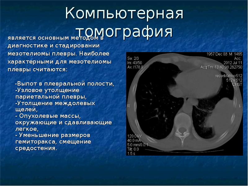 Мезотелиома плевры кт картина