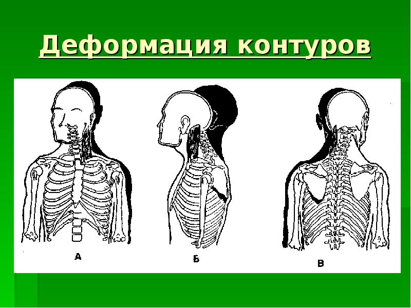 Грудная сосцевидная мышца. Деформация контуров изображения. Визуальная диагностика. Триггерная точка в грудино сосцевидной мышце. Ключичное дыхание