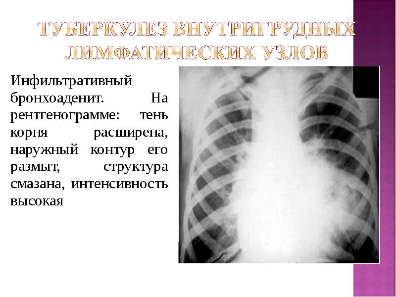 Легочные корни расширены. Инфильтративный туберкулез рентген. Очагово-инфильтративный туберкулез рентген. Инфильтративный бронхоаденит рентген. Инфильтративная форма туберкулезного бронхоаденита.