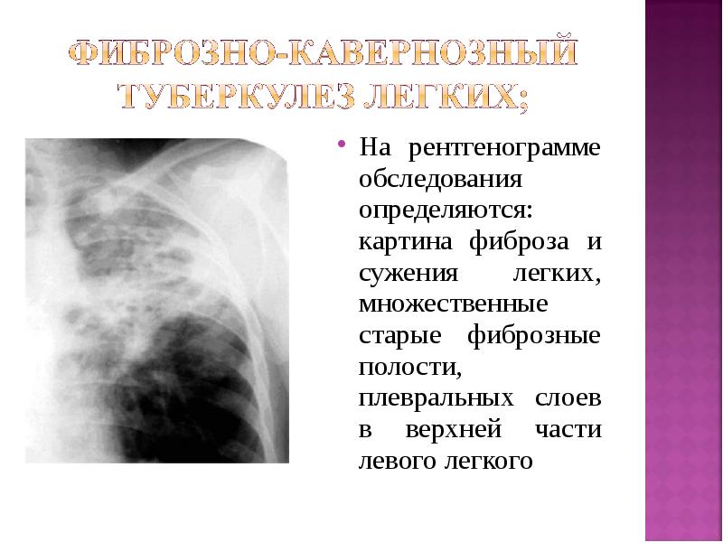 Легких форум. Плевроперикардиальный фиброз легких. Фиброз легких заключение. Плевральный фиброз легких.