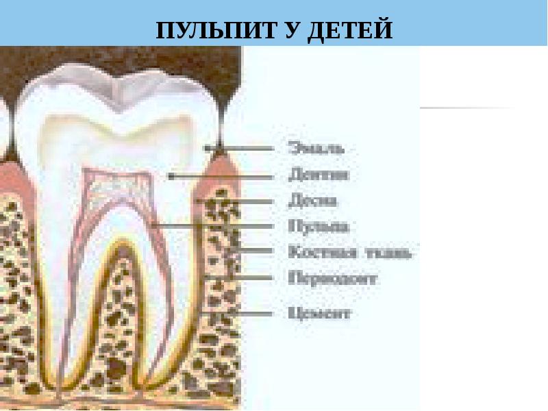 Пульпит временных и постоянных зубов у детей презентация