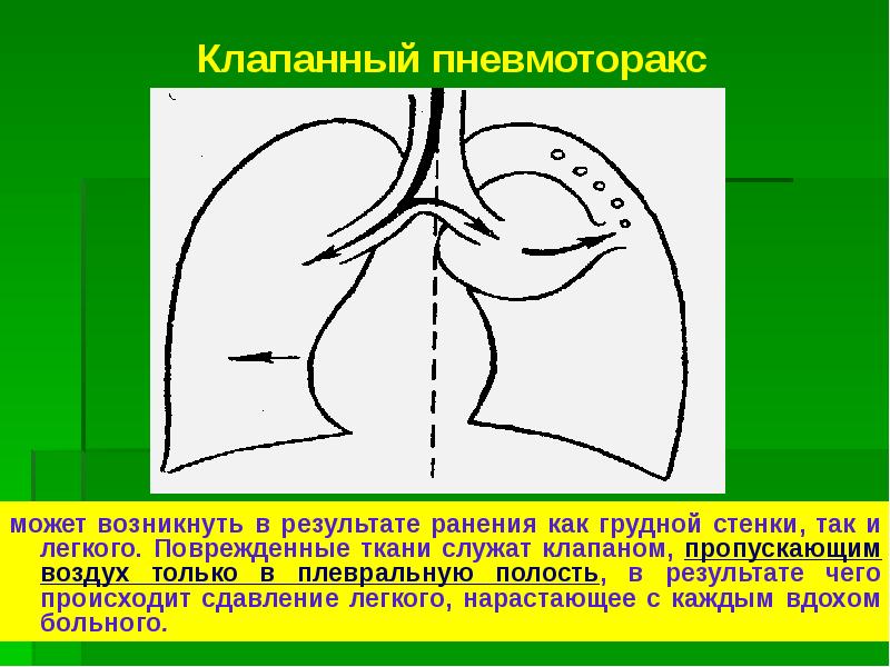 Презентация повреждения грудной клетки