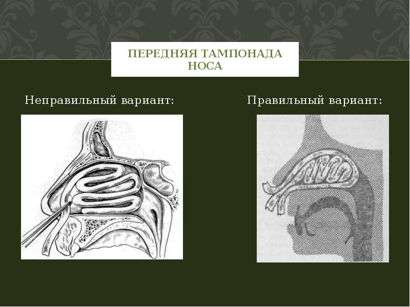 Носовые кровотечения у детей презентация