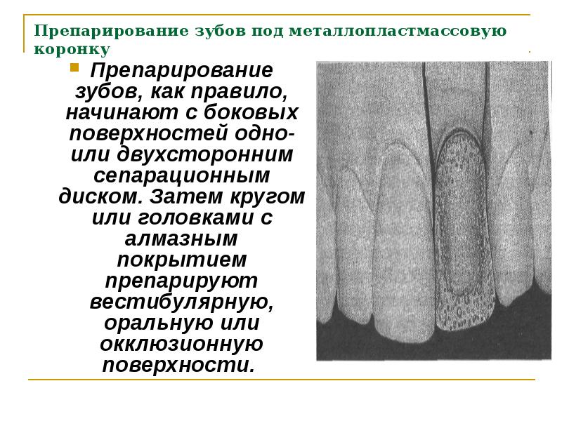 Препарирование зуба под фарфоровую коронку. Препарирование зуба под фарфоровую коронку. Препарирование зуба под фарфоровую коронку. Этапы изготовления пластмассовых коронок. Препарирование зуба под фарфоровую коронку.