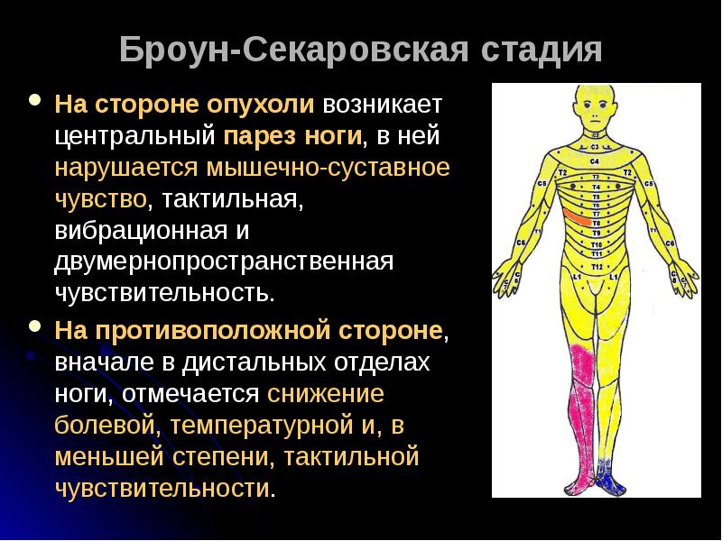 Презентация опухоль спинного мозга