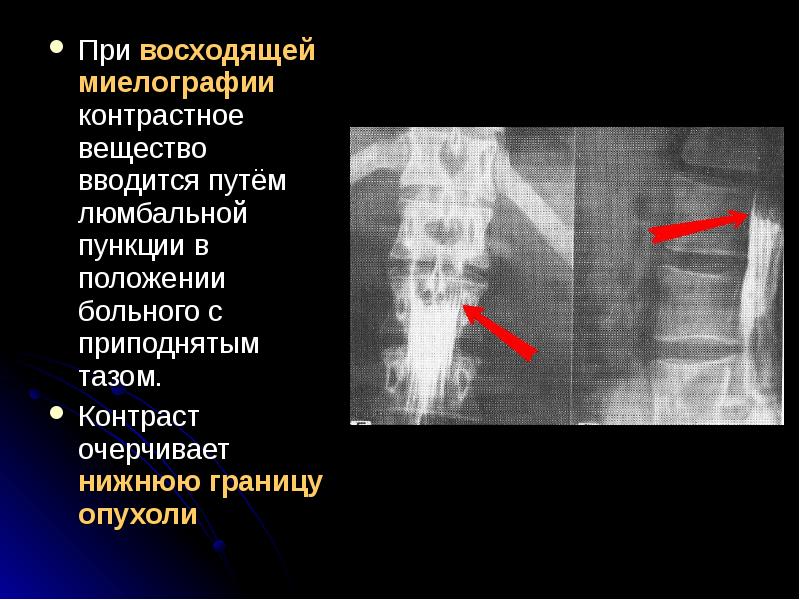 Опухоли спинного мозга презентация