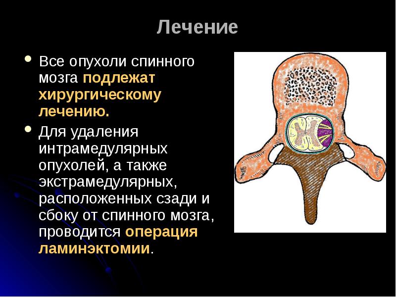 Опухоли головного и спинного мозга презентация