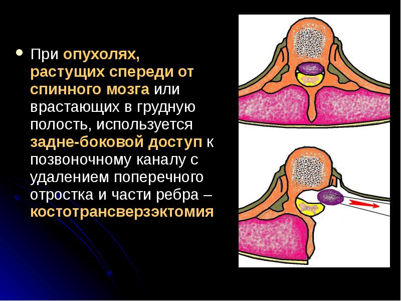 Опухоли спинного мозга неврология