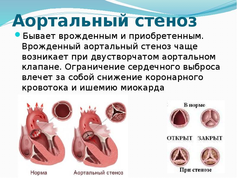 Врожденные и приобретенные пороки сердца презентация