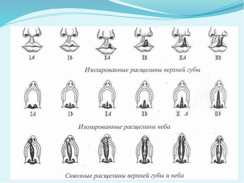 Виды расщелин губы и неба при ринолалии схема