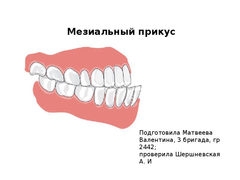 Мезиальный прикус презентация