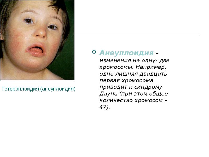 Гетероплоидия (анеуплоидия)
Анеуплоидия – изменения на одну- две хромосомы. Например, Гетероплоидия (анеуплоидия)
Анеуплоидия – изменения на одну- две хромосомы. Например,
