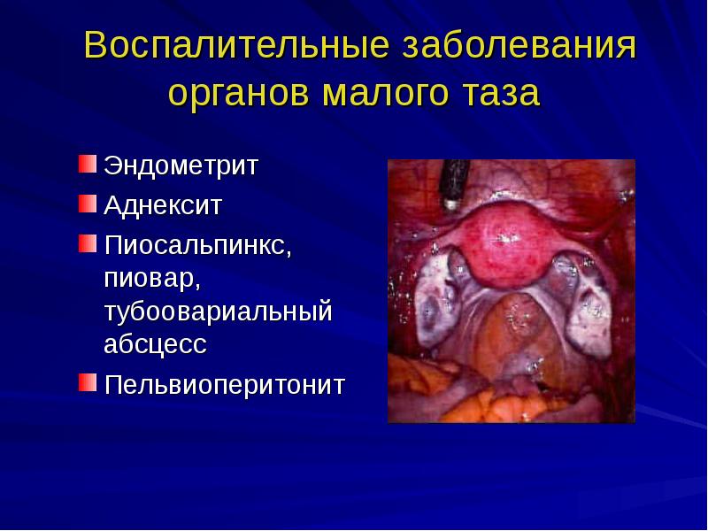 Воспаление женских органов презентация