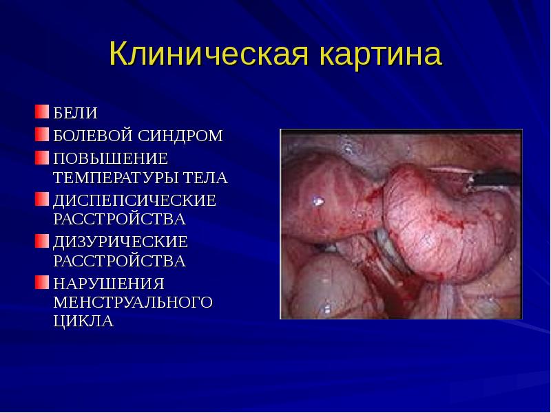 Воспаление женских органов презентация