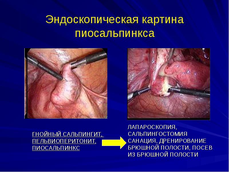 Воспаление женских органов презентация