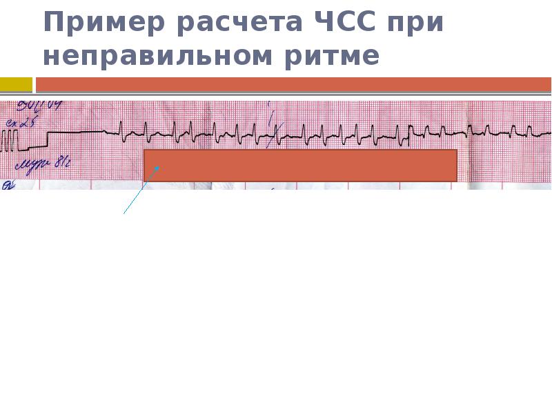 Чсс по экг