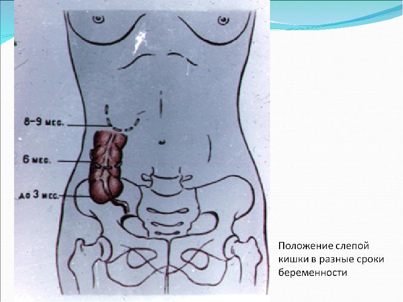 Скачать презентацию на тему острый аппендицит
