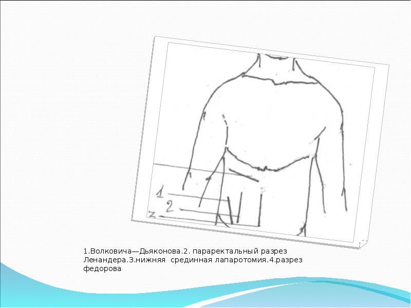 Скачать презентацию на тему острый аппендицит