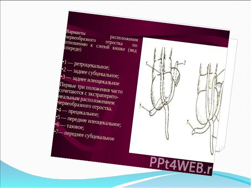 Хронический аппендицит презентация