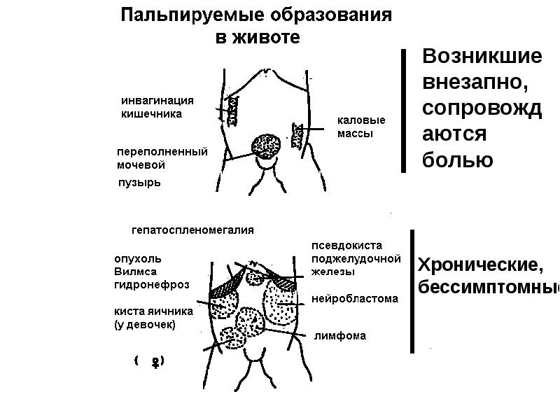 Синдром пальпируемой опухоли у детей презентация