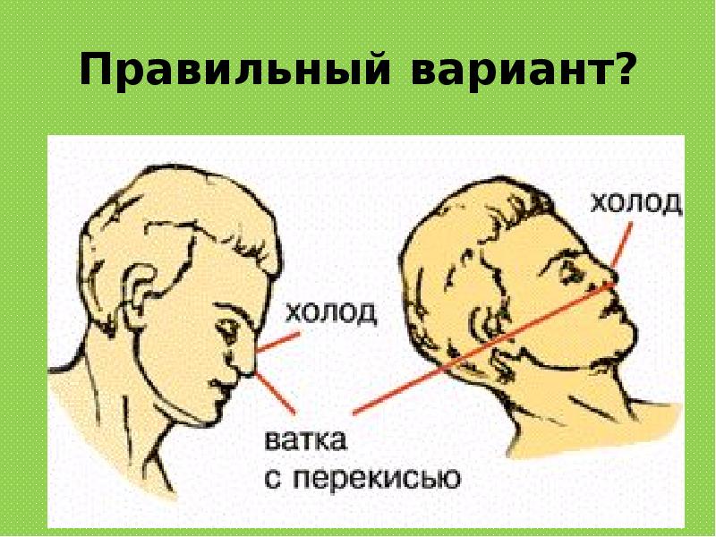 На каком из рисунков наиболее правильно показан метод остановки кровотечения из носа