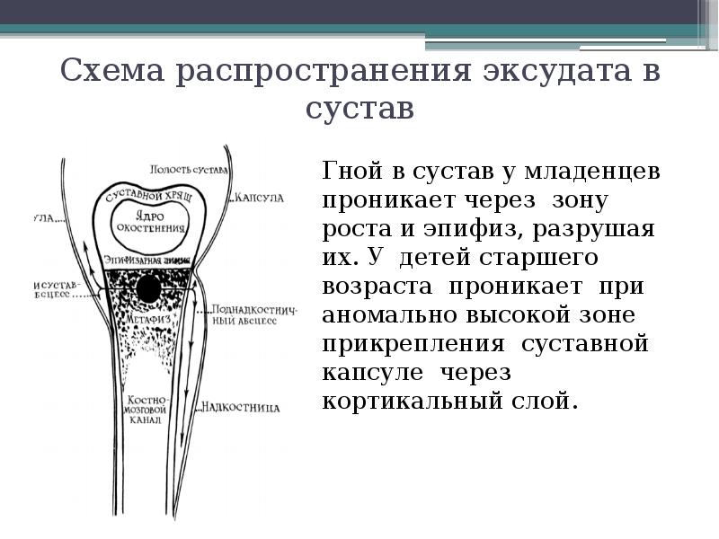 Остеомиелит у детей презентация