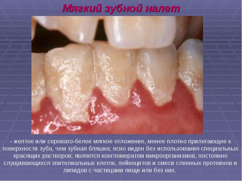 Презентация лечение кариеса молочных зубов