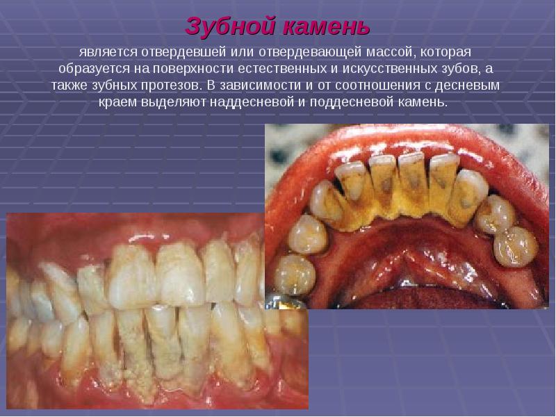 Презентация лечение кариеса молочных зубов