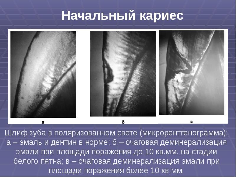 Презентация лечение кариеса молочных зубов