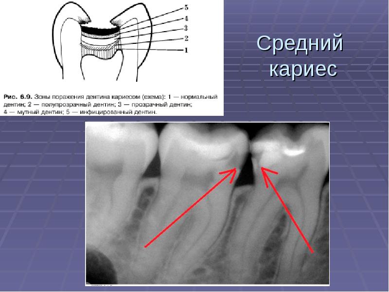 Презентация лечение кариеса молочных зубов