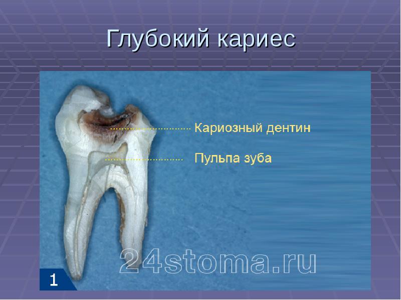 Презентация лечение кариеса молочных зубов