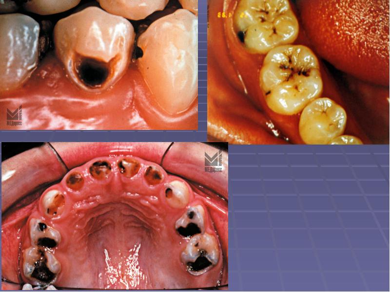 Презентация лечение кариеса молочных зубов