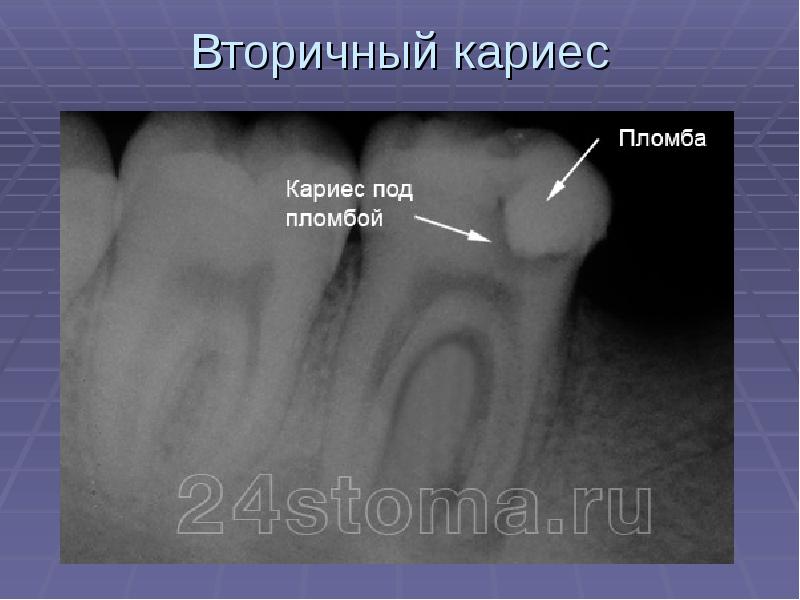 Презентация лечение кариеса молочных зубов