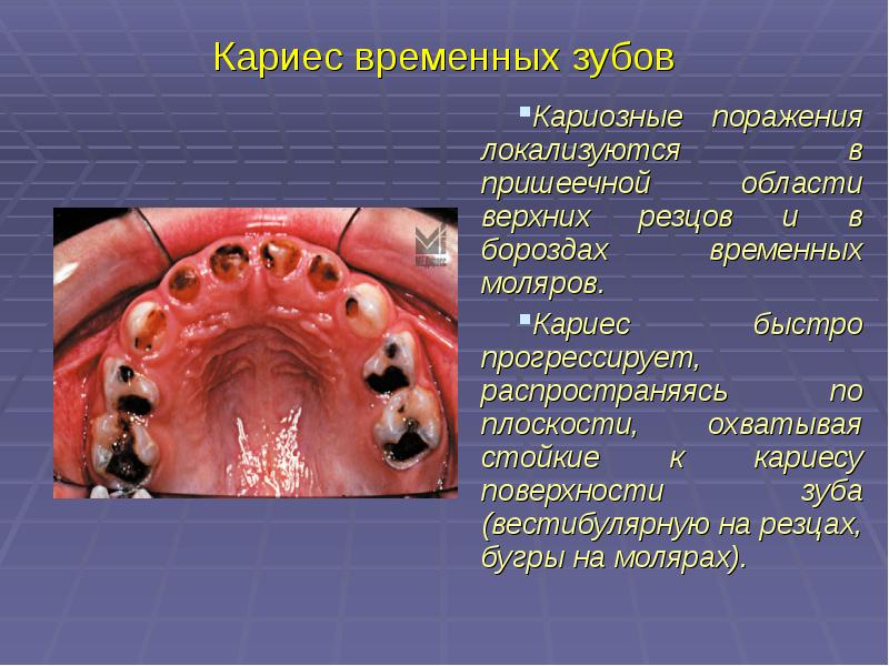 Презентация лечение кариеса молочных зубов