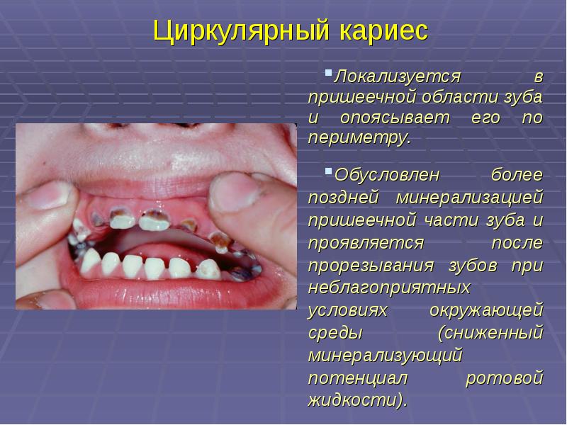 Презентация лечение кариеса молочных зубов