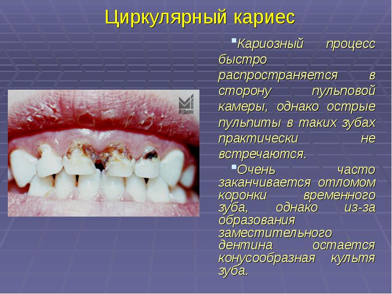 Презентация лечение кариеса молочных зубов