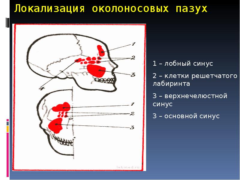 Презентация на тему гайморит