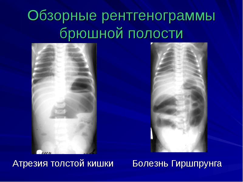 Врожденная кишечная непроходимость презентация