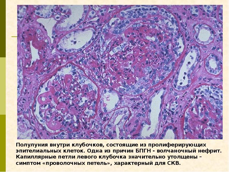 Гломерулонефрит презентация по терапии