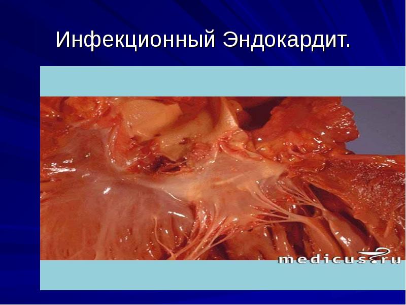 Инфекционный Эндокардит. Инфекционный Эндокардит.