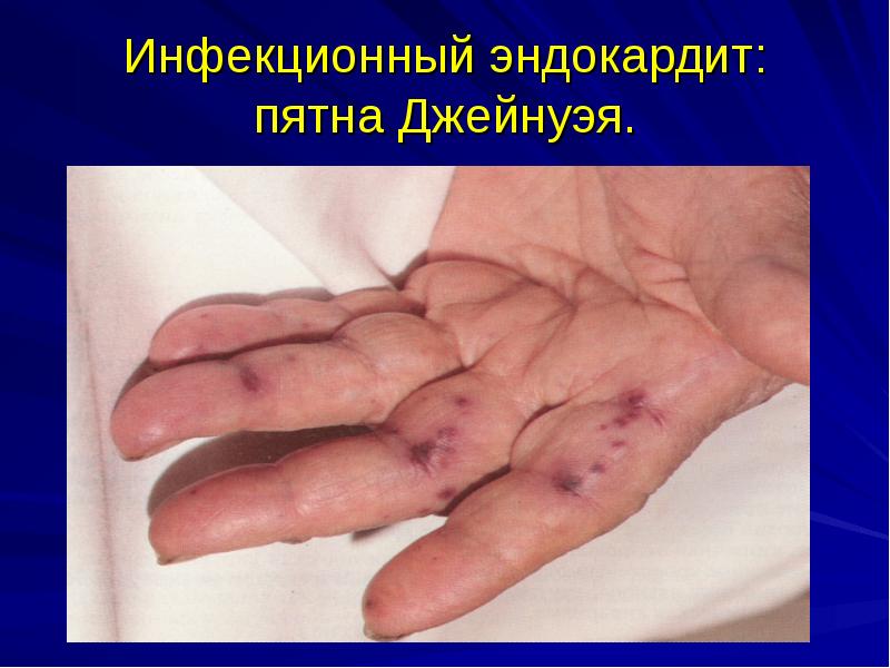 Инфекционный эндокардит: пятна Джейнуэя. Инфекционный эндокардит: пятна Джейнуэя.