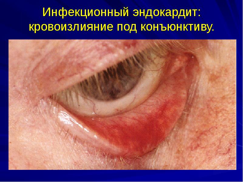 Инфекционный эндокардит: кровоизлияние под конъюнктиву. Инфекционный эндокардит: кровоизлияние под конъюнктиву.