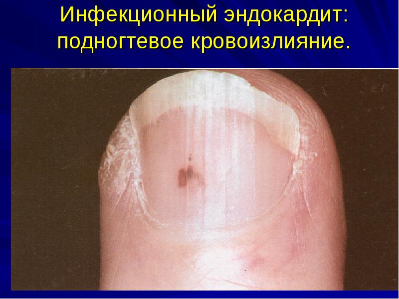 Инфекционный эндокардит: подногтевое кровоизлияние. Инфекционный эндокардит: подногтевое кровоизлияние.